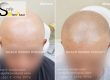Hair loss treatment Phuket
