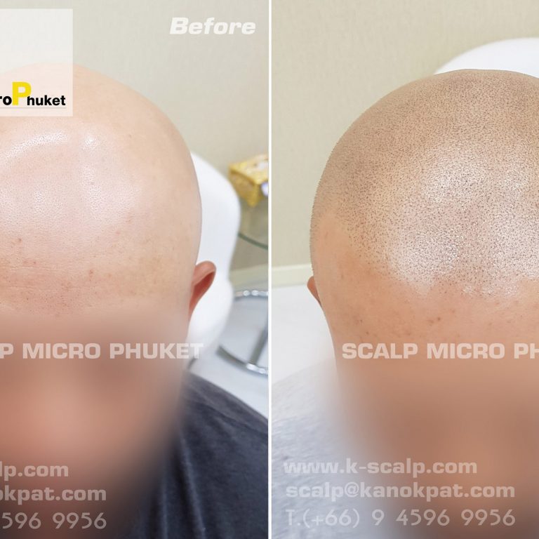 Hair loss treatment Phuket Hair loss treatment Phuket
