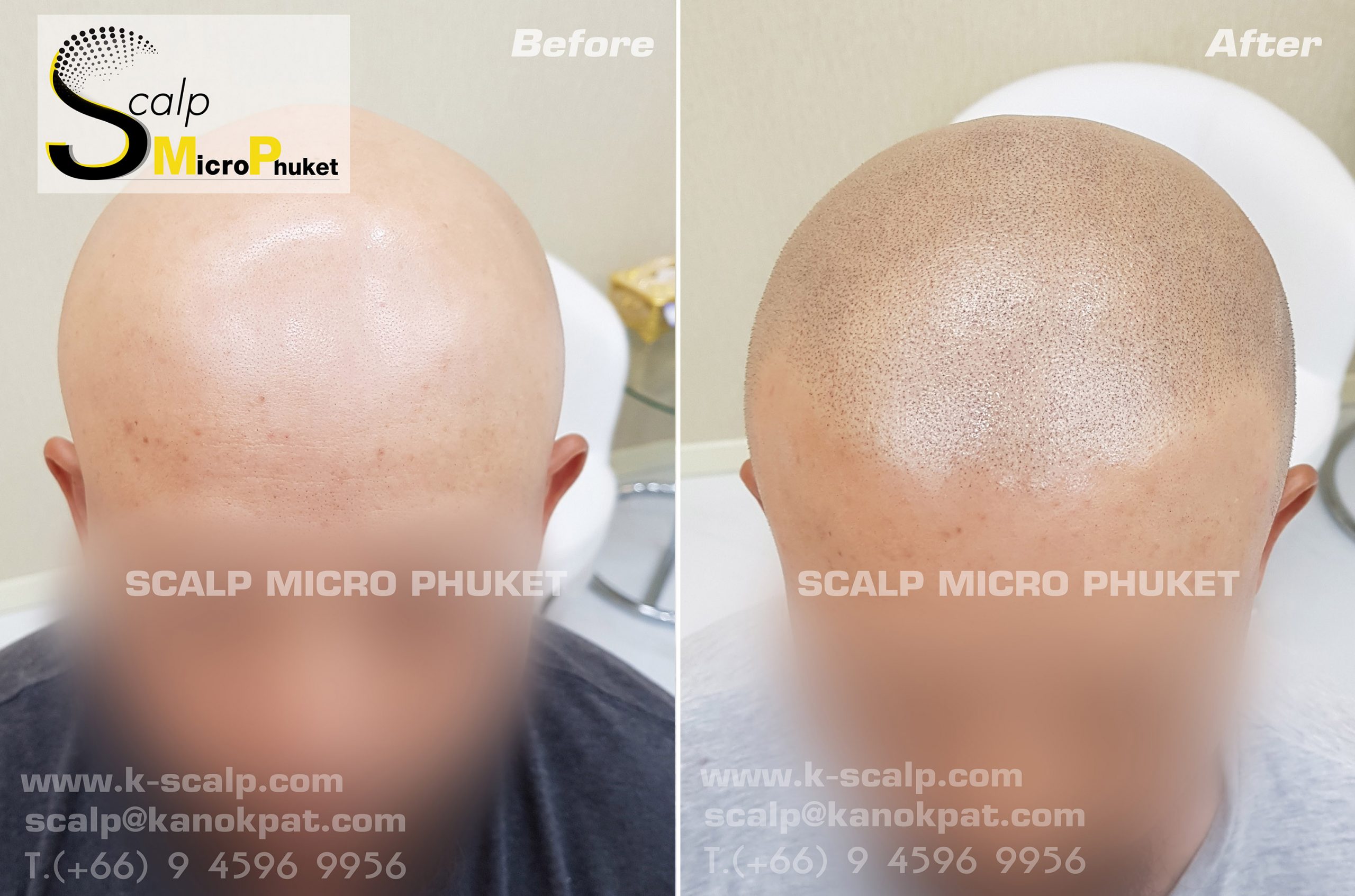 Hair loss treatment Phuket Hair loss treatment Phuket
