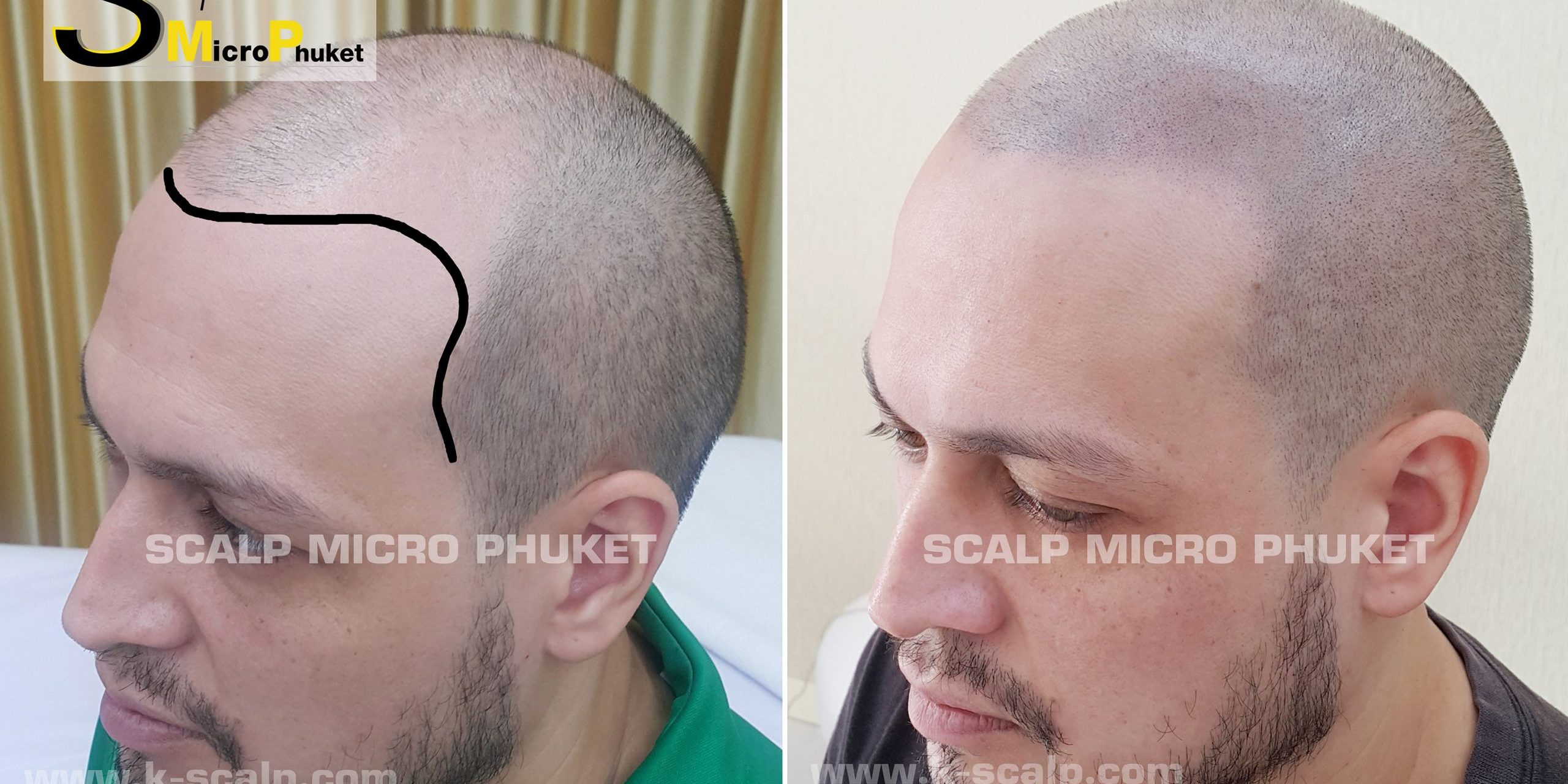 Baldness Treatment Baldness Treatment