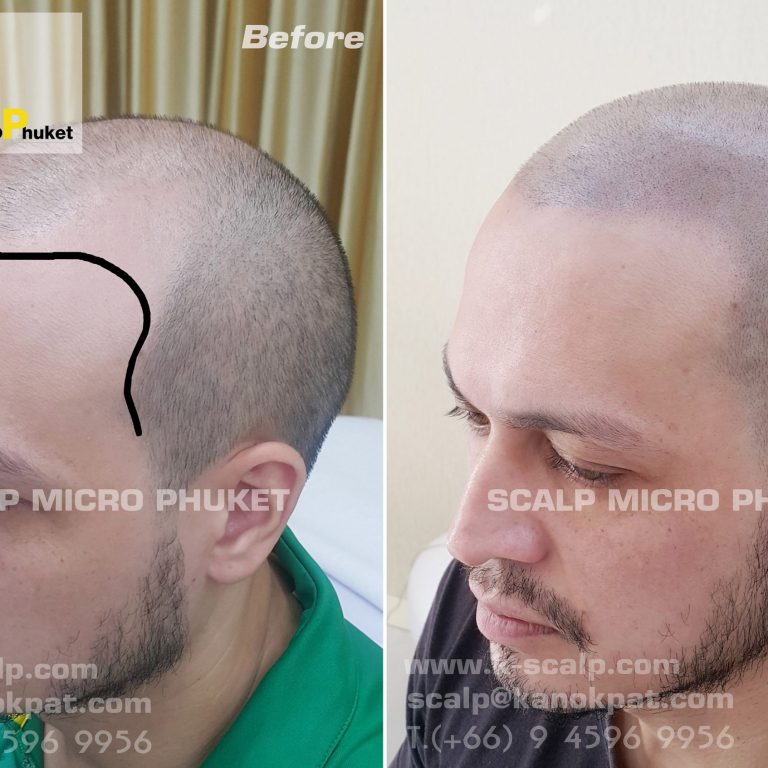 Baldness Treatment Baldness Treatment
