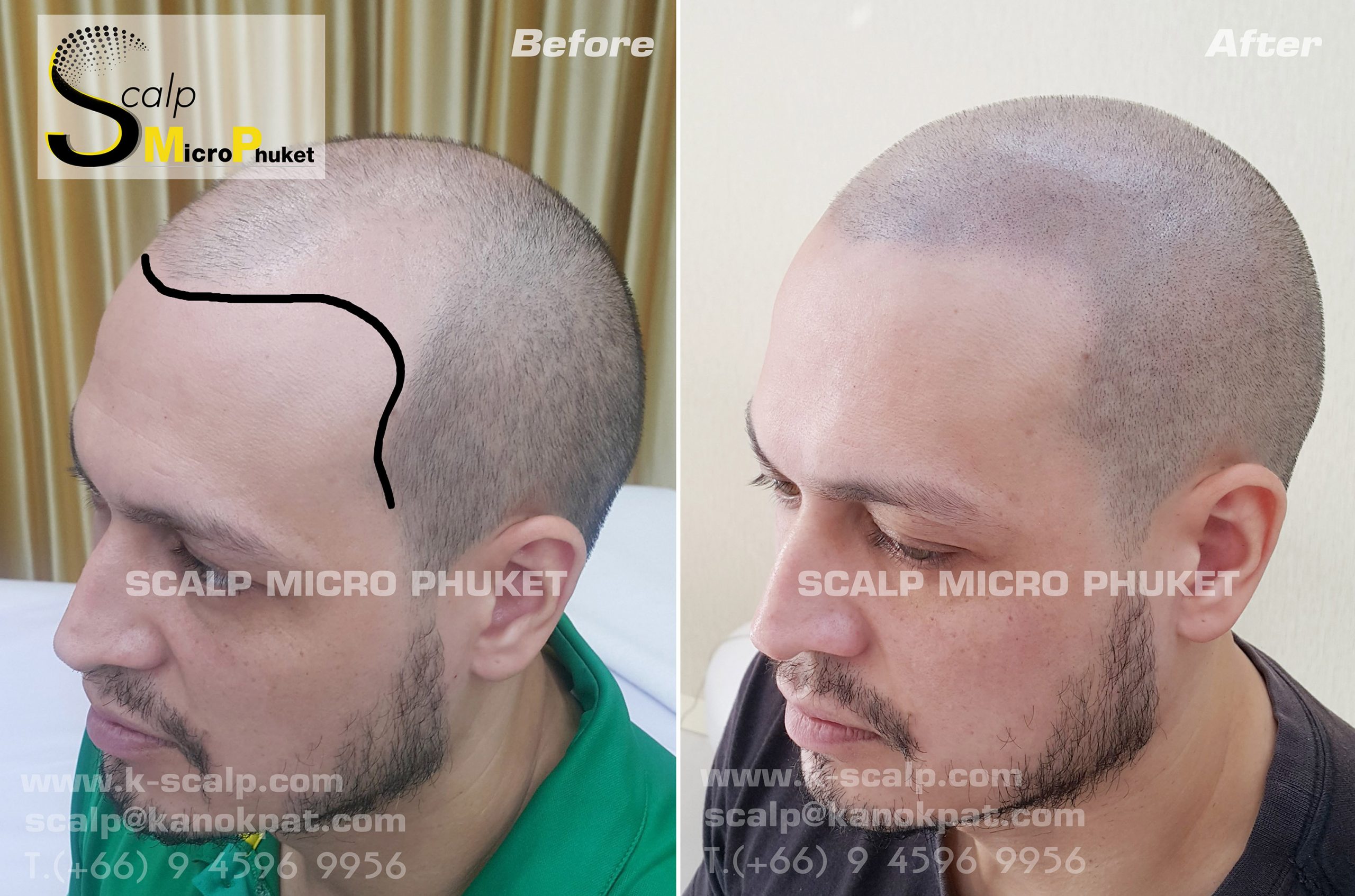 Baldness Treatment Baldness Treatment