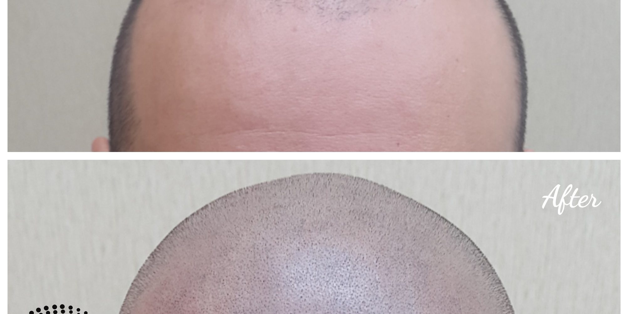 Why chose Scalp-micro in Phuket