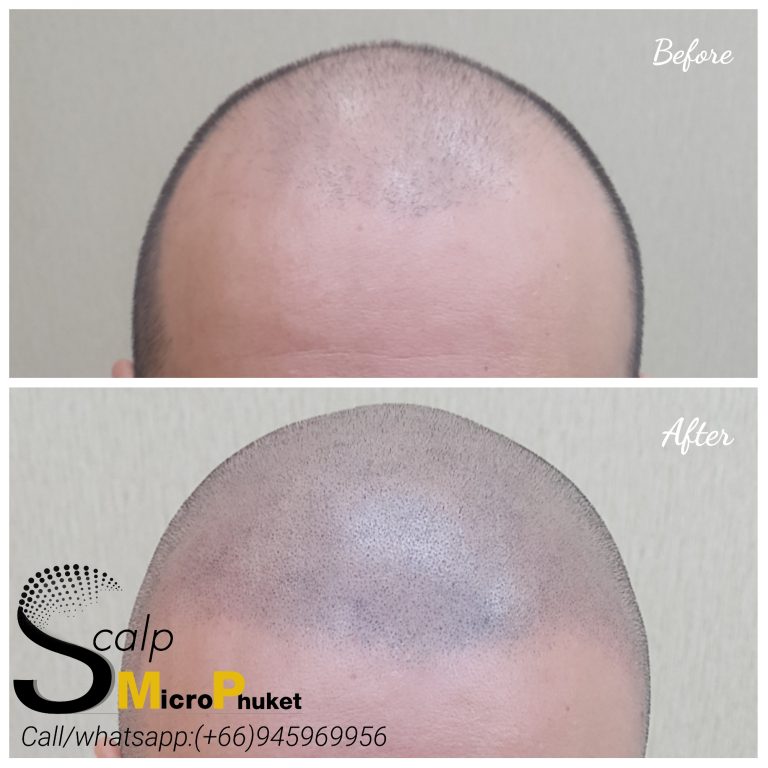 Why chose Scalp-micro in Phuket Why chose Scalp-micro in Phuket