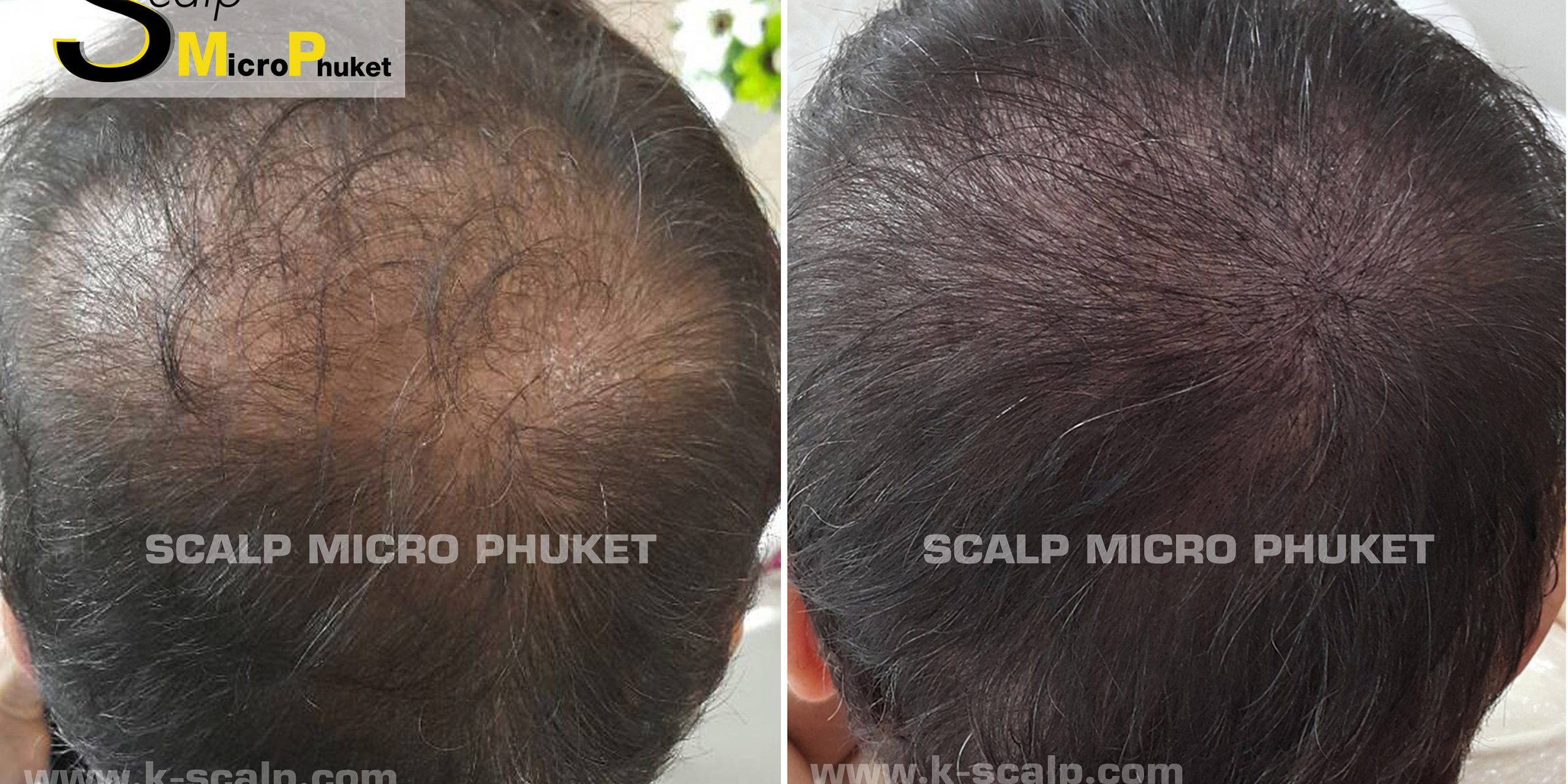 Hair loss Problems