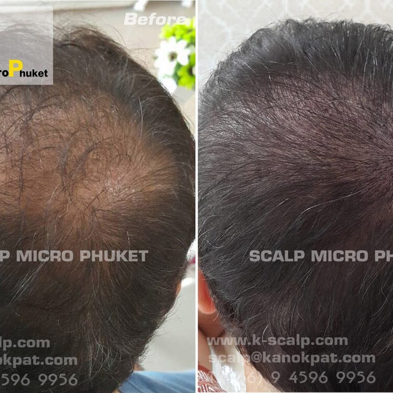 Hair loss Problems Hair loss Problems