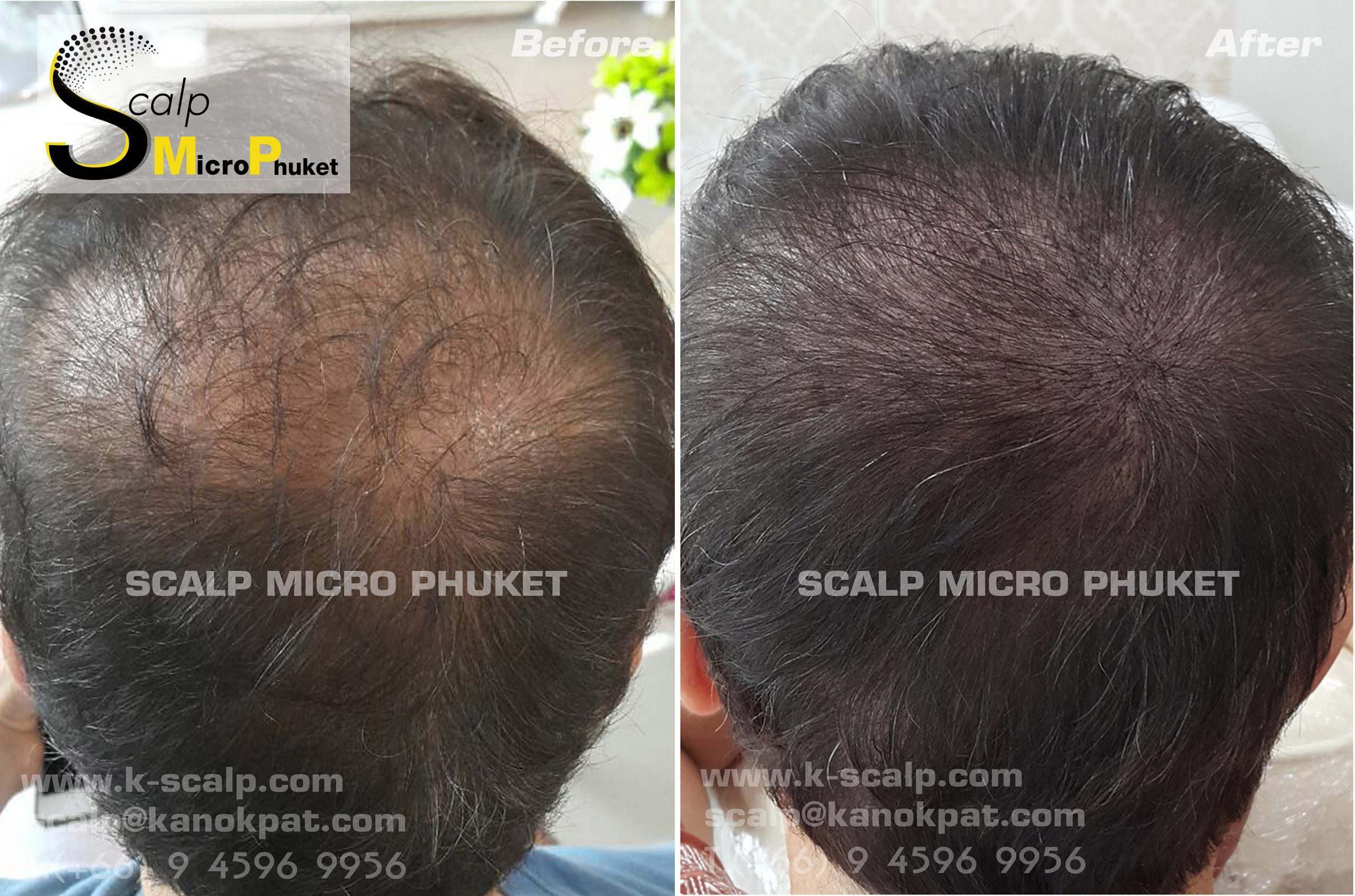 Hair loss Problems Hair loss Problems