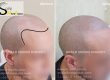 Perfect baldness treatment