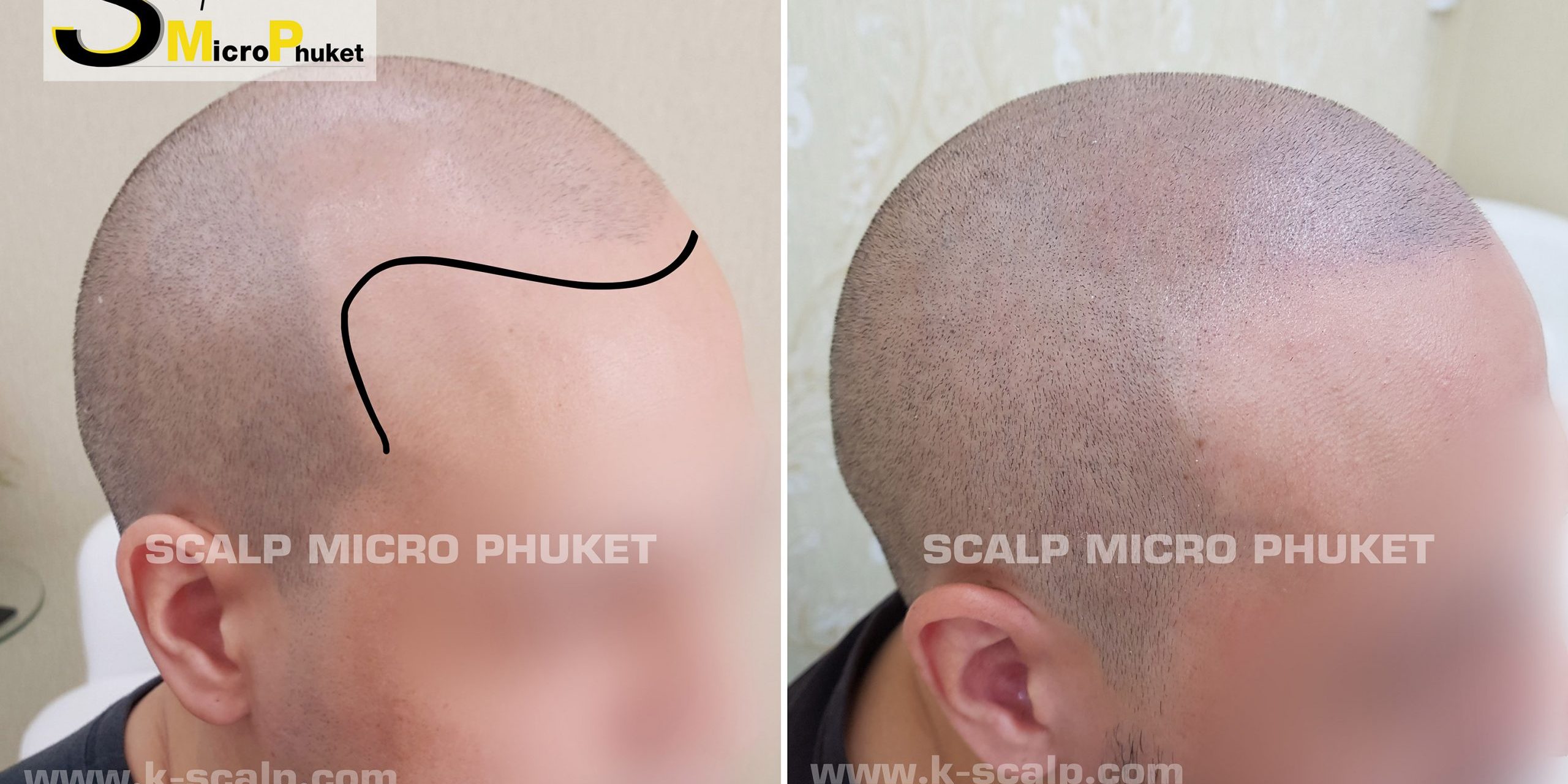 Perfect baldness treatment