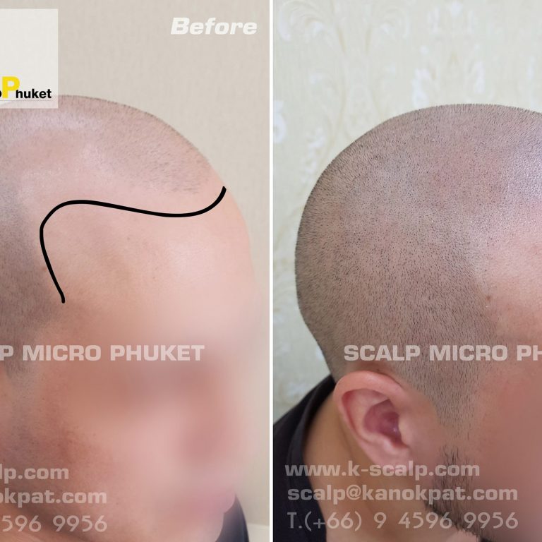 Perfect baldness treatment Perfect baldness treatment