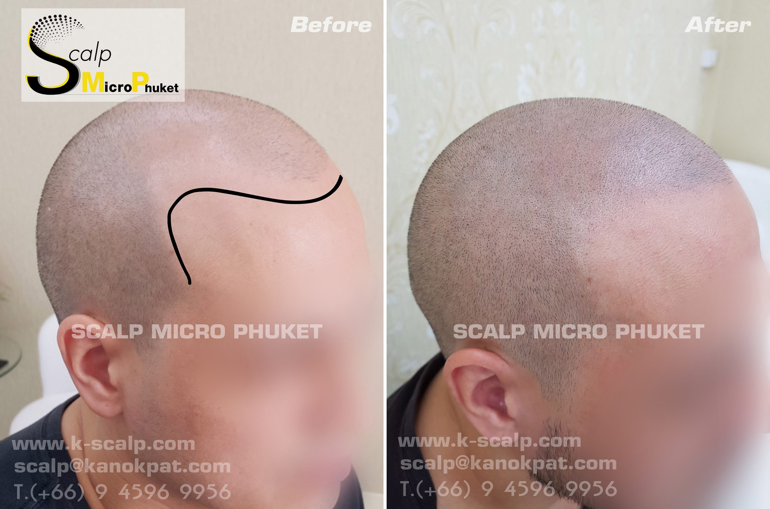Perfect baldness treatment Perfect baldness treatment