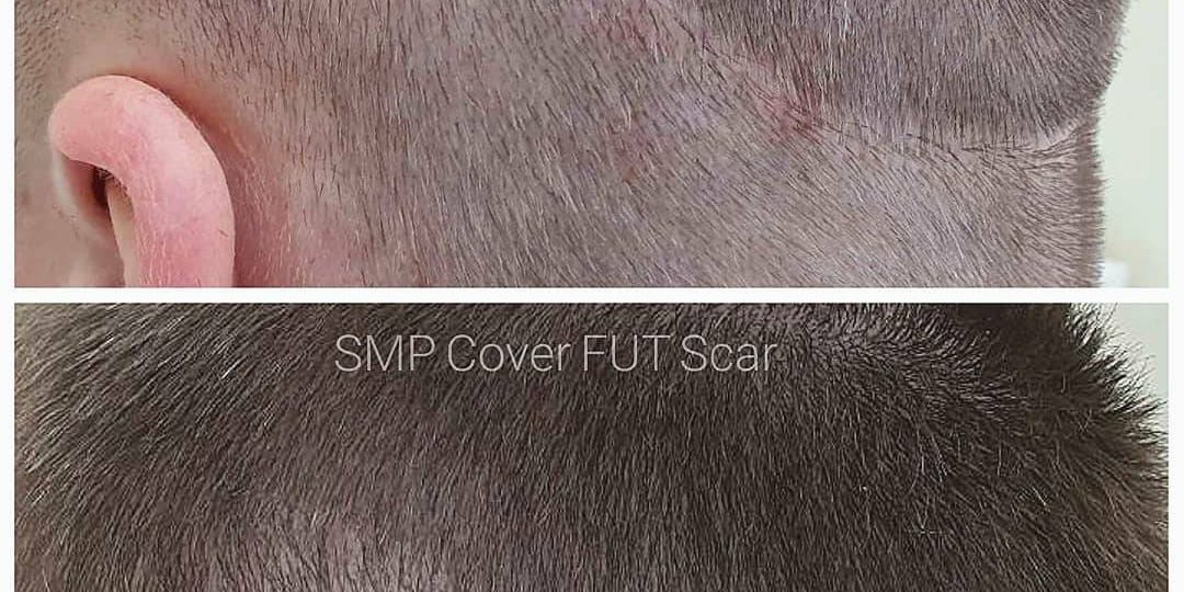 Scalp micro-pigmentation : the best alternative to hair transplantation