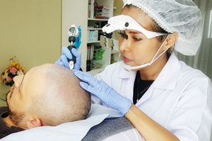 Scalp Micro Pigmentation
